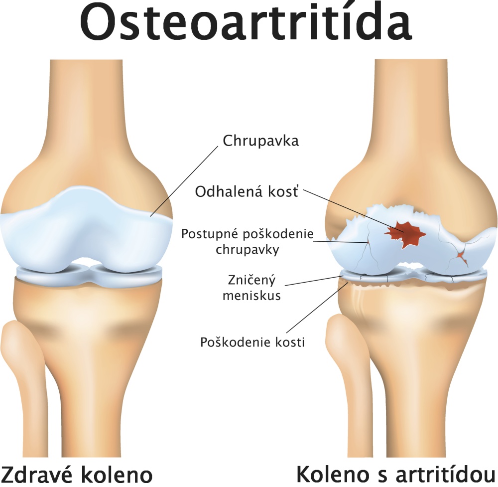 osteoartritida koleno zdrave a poskodene koleno popis